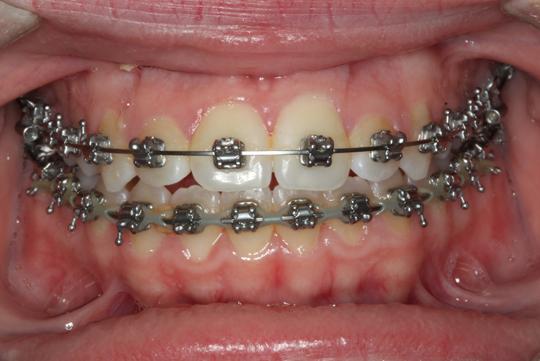 Curso de Biomecánica para el Odontólogo con Enfoque en Ortodoncia