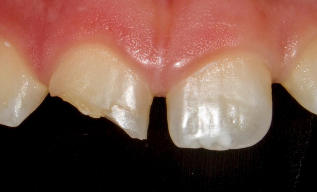 21 AGOSTO / Curso de Manejo de Traumatismo Dentoalveolar en Dentición Permanente