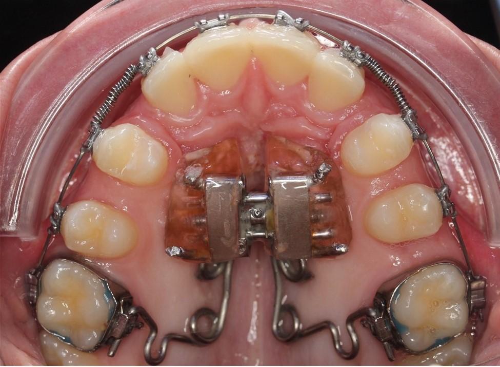15 SEPT 2025 / Diplomado de Postítulo en Análisis Cráneo Facial Morfofuncional, influencia en el Diagnóstico y Tratamiento Ortodóntico Preventivo en Interceptivo