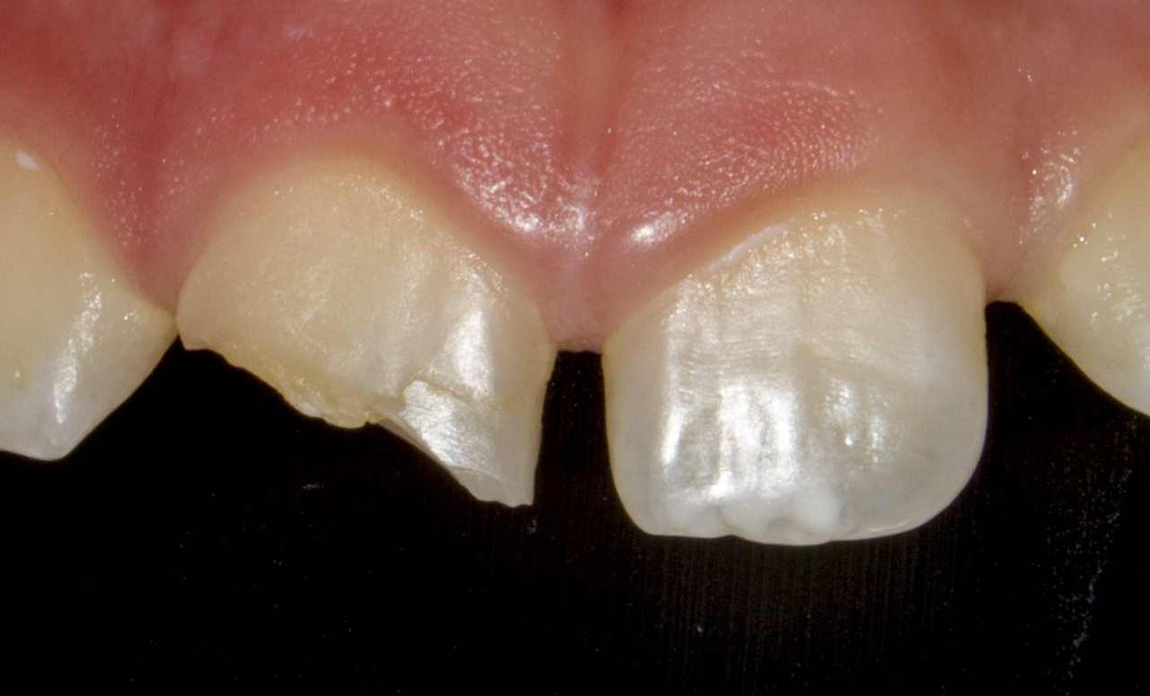19 JUNIO / Curso de Manejo de Traumatismo Dentoalveolar en Dentición Permanente