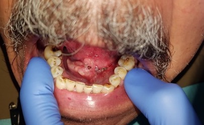 26 SEPT / Curso Actualización en Patología Oral para el Odontólogo General